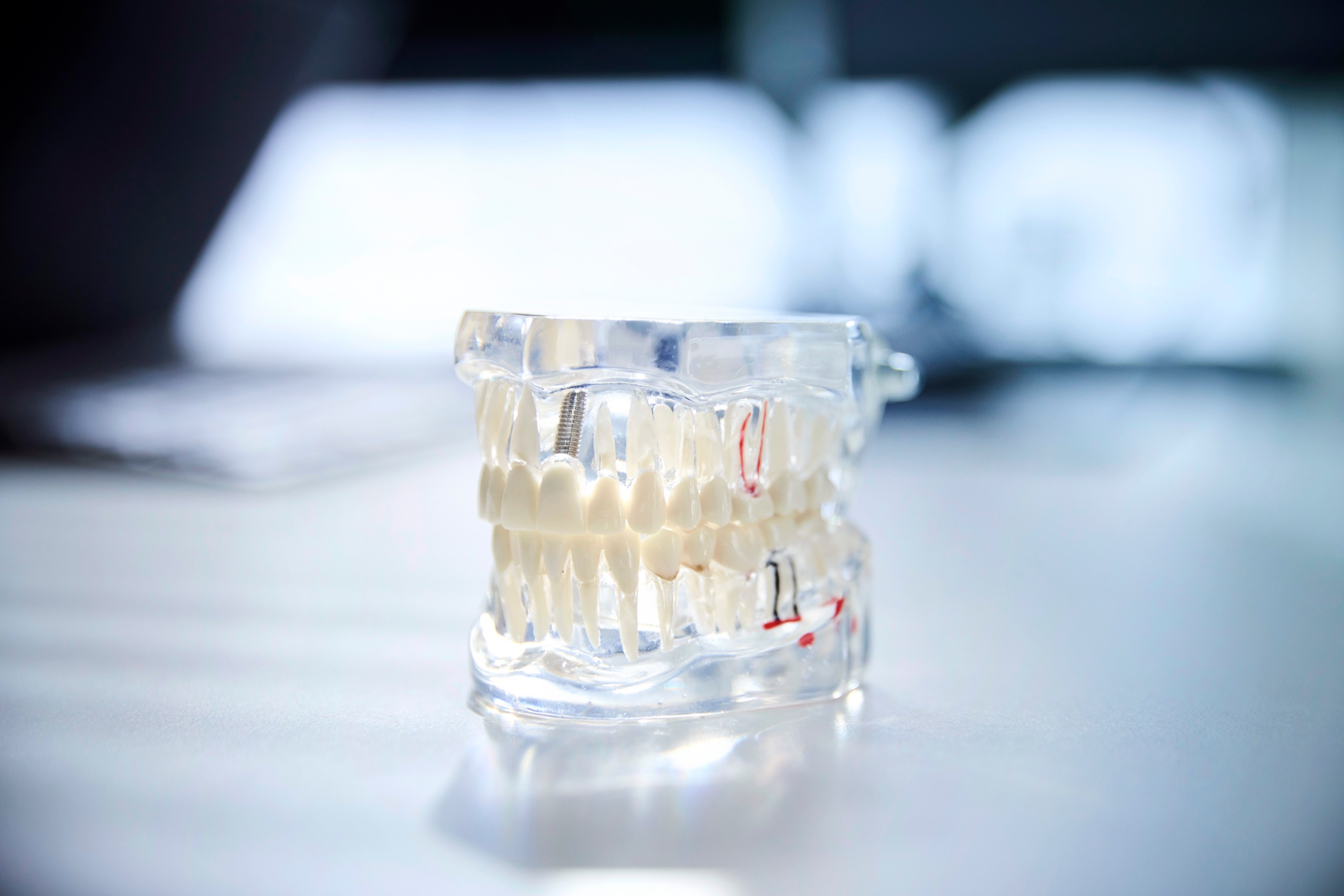 Transparentes Anschauungsmodell eines Kiefers mit einem Implantat